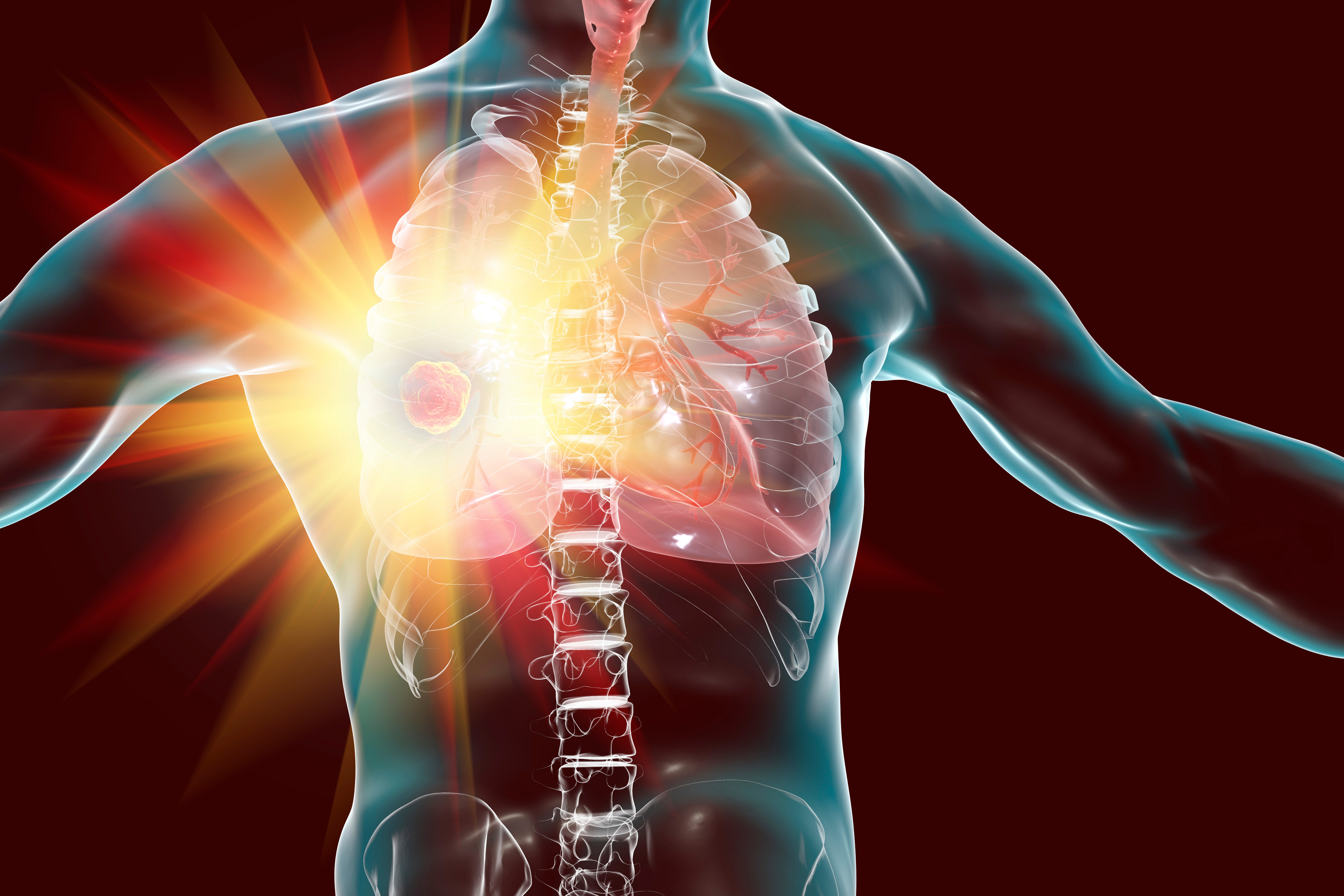 Five Year Update on ADAURA Clinical Trial of Tagrisso in EGFR Early Stage NSCLC