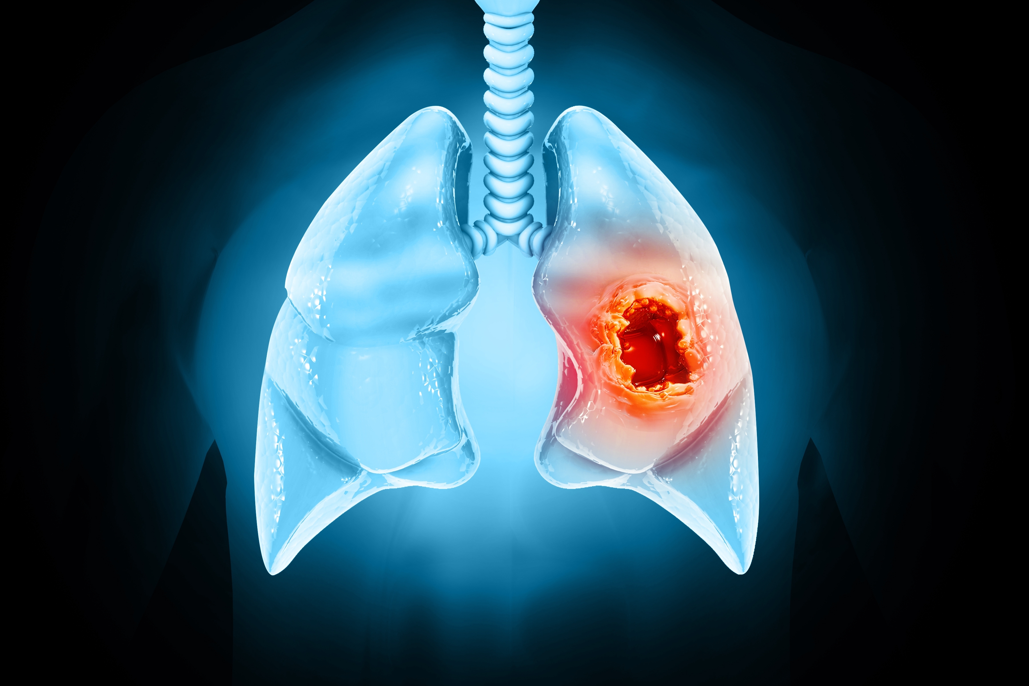 Advances in the Management of Stage III NSCLC –Impact of the LAURA Clinical Trial