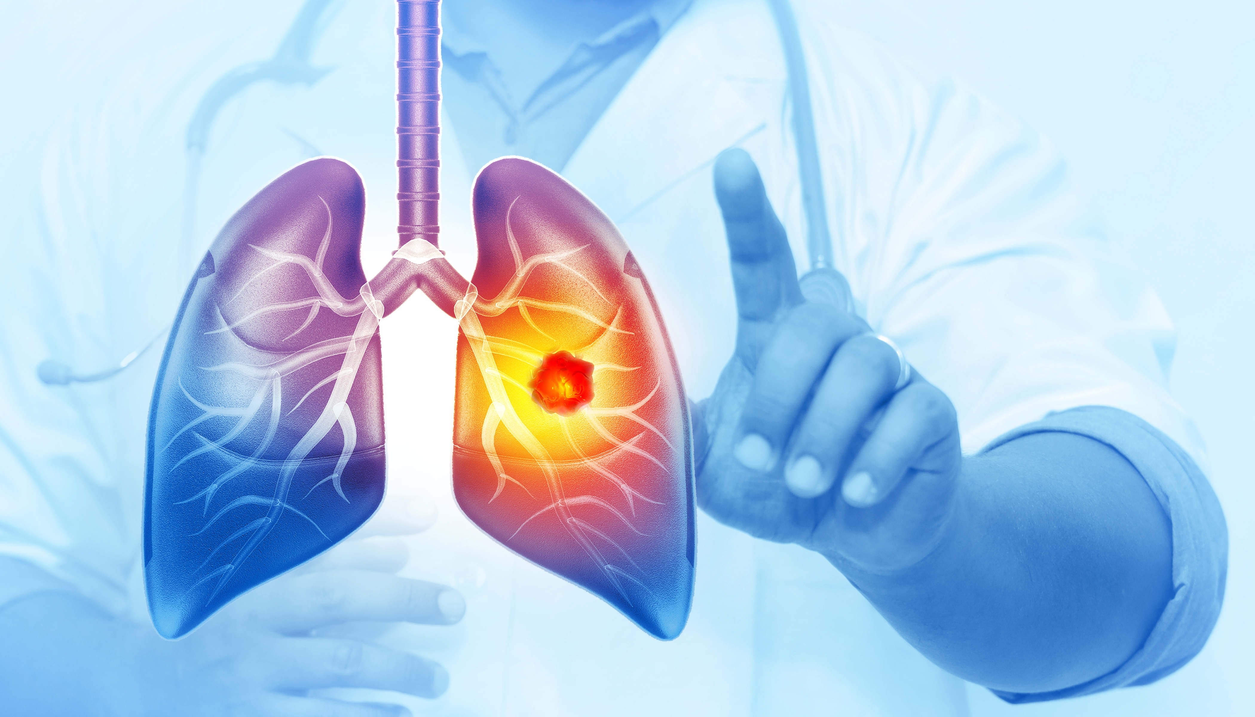 Molecular Testing and the Implications for 1L Therapy in Stage IV EGFRm NSCLC