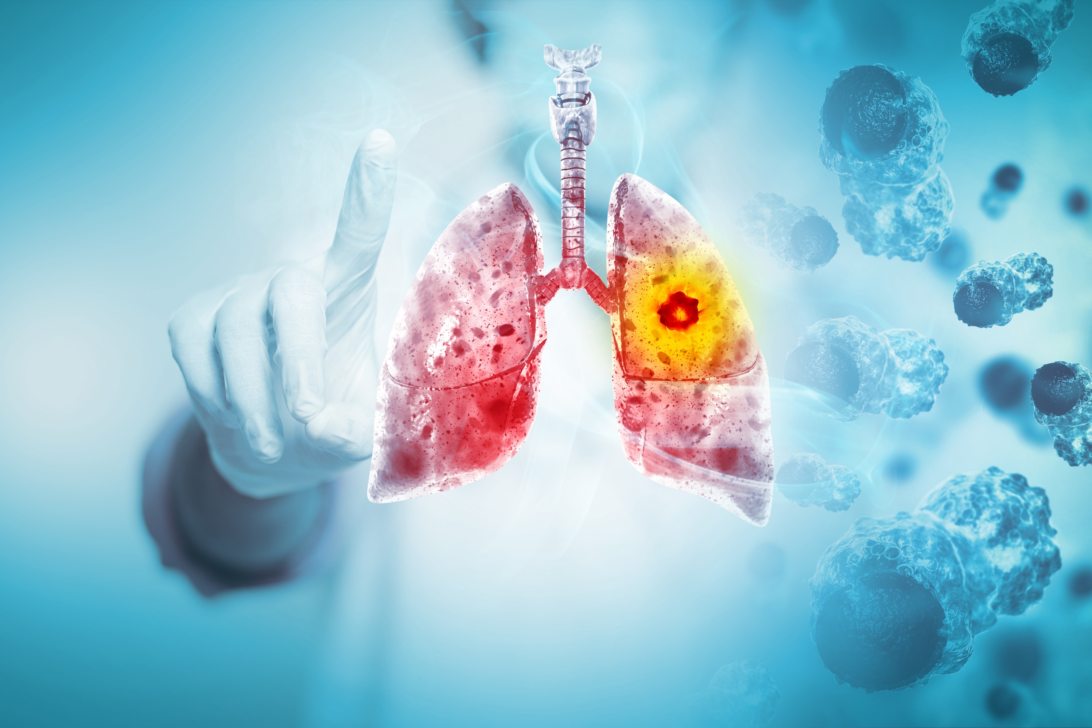 Advances in the Management of Extensive Small Cell Lung Cancer