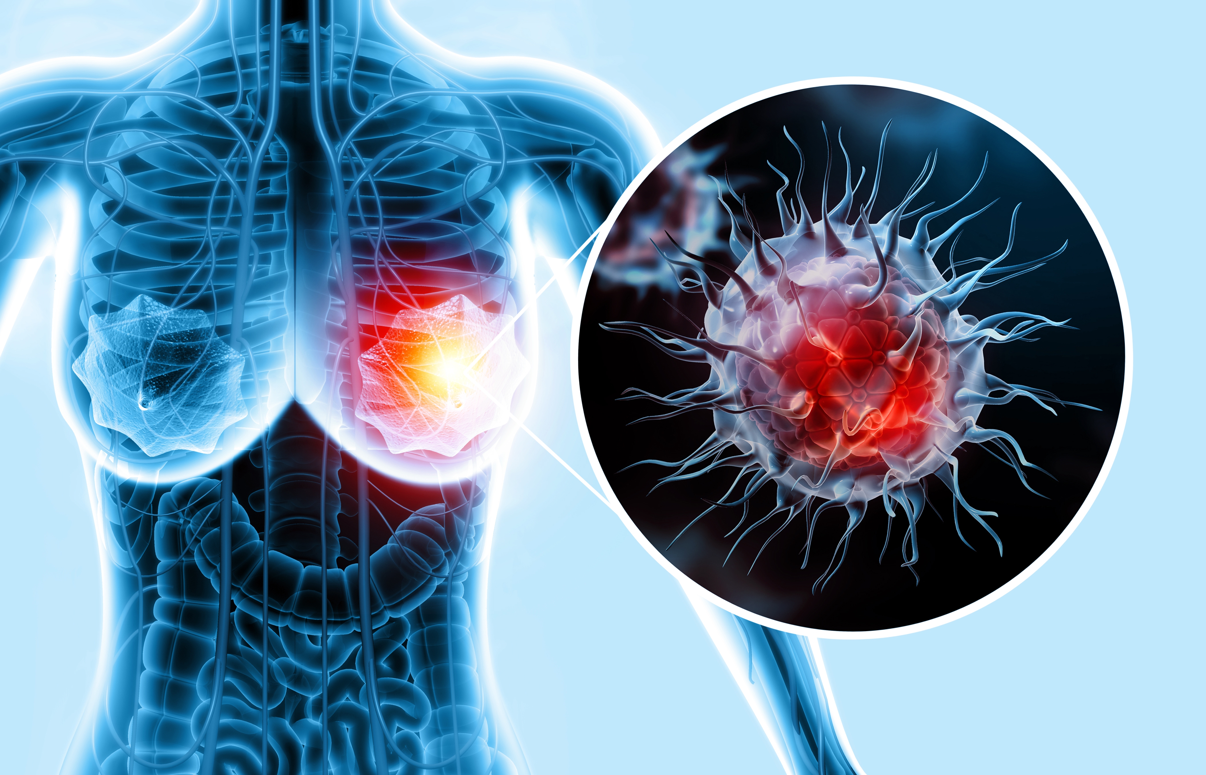 The Future is Now: ctDNA in Breast Cancer