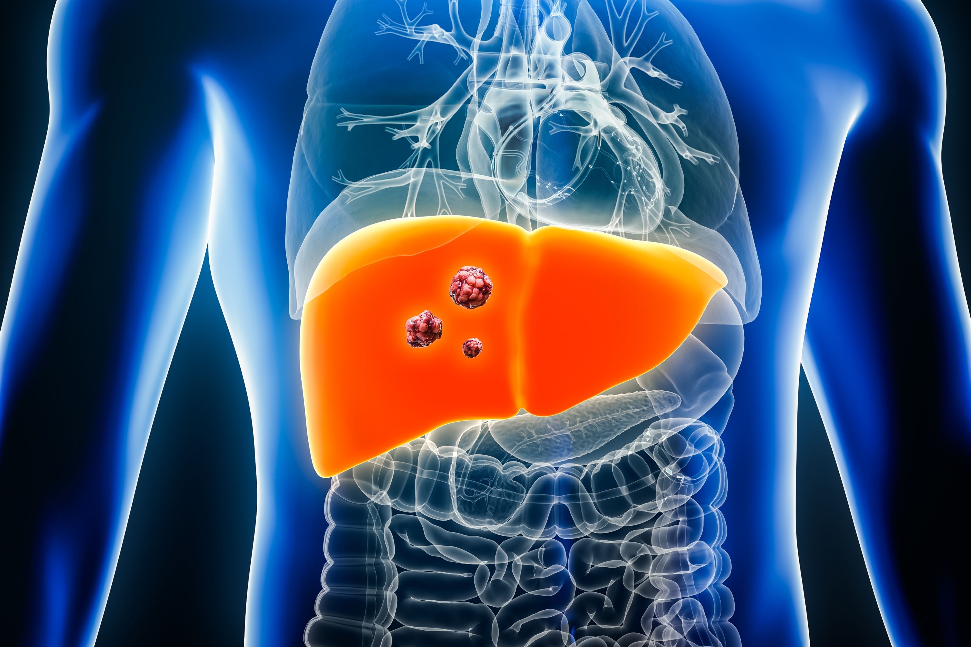 The Role of IO Based Therapy in Patients with HCC: An All Stage Strategy?