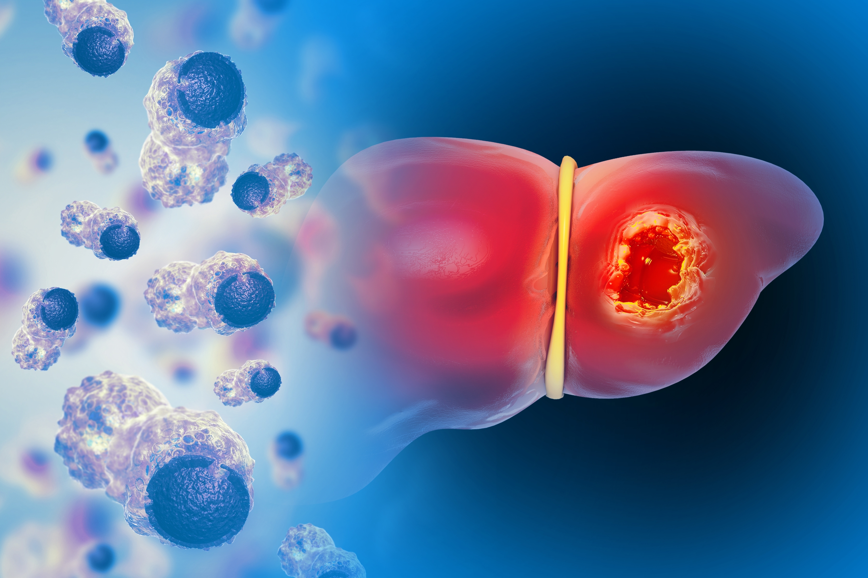 Recent Advances in the Management of Advanced Hepatocellular Cancer