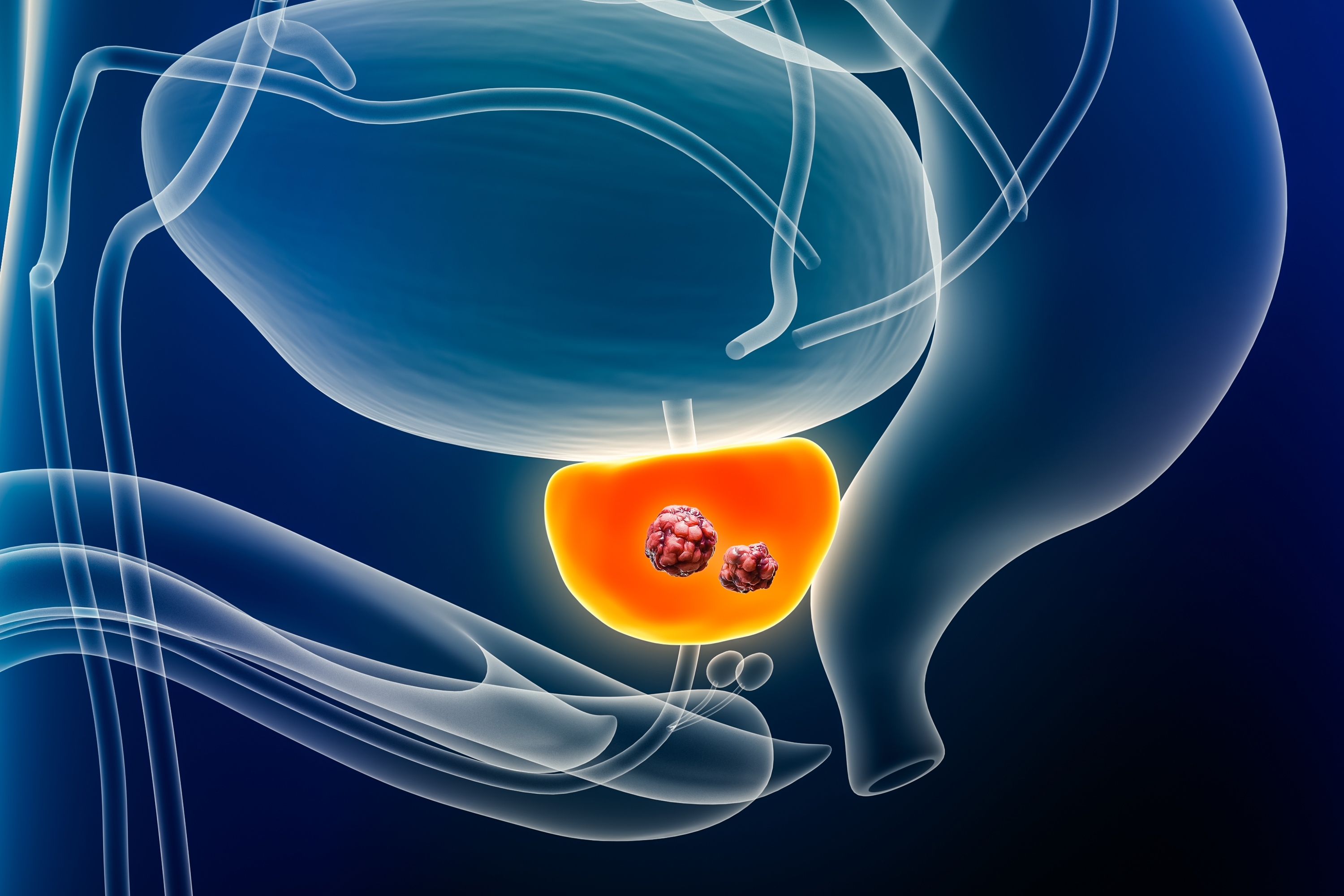 Prostate Cancer with NTRK Fusion