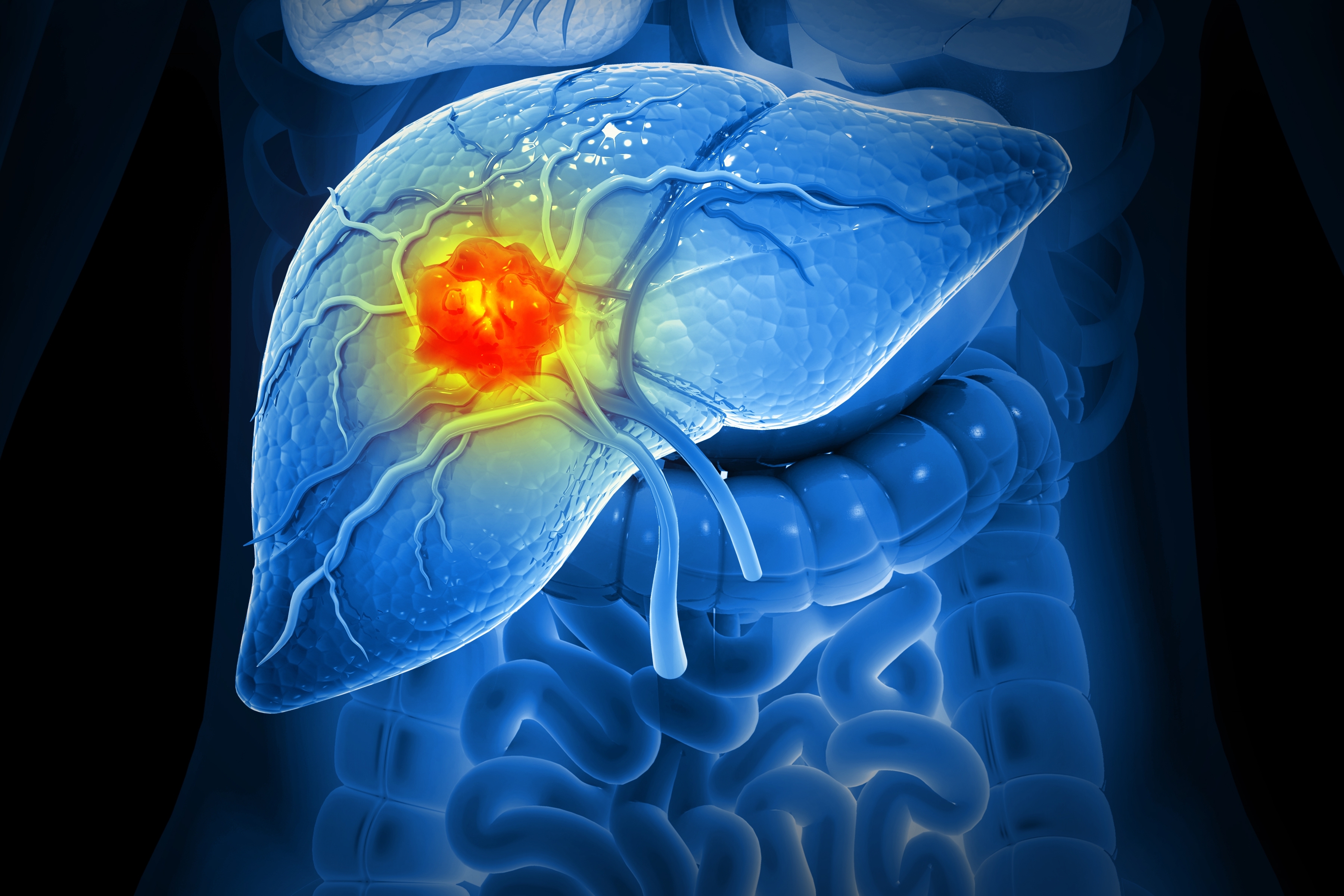 ctDNA and Its Role in Hepatocellular Carcinoma