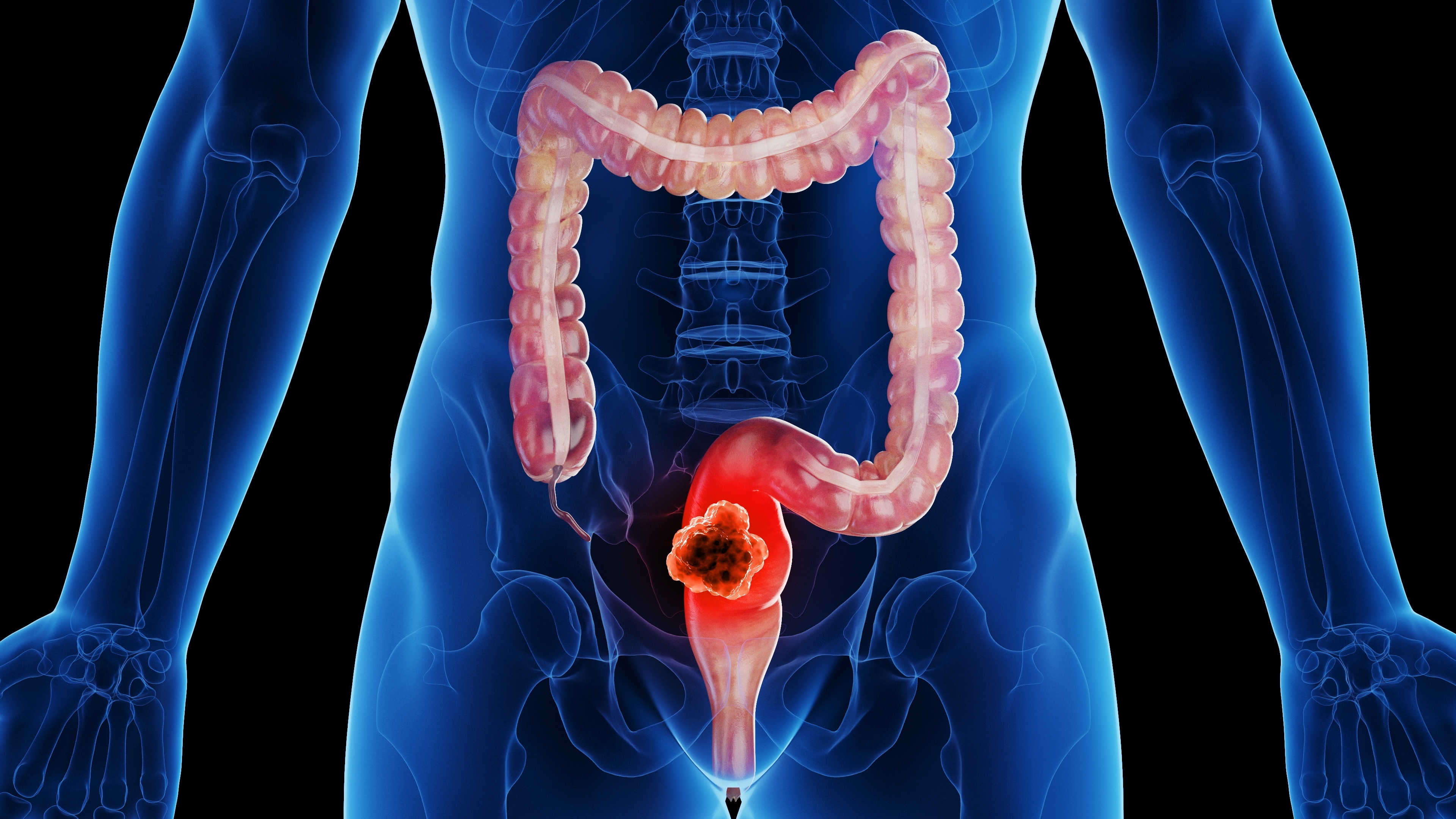 ctDNA-Guided Surveillance in Non-Operative Rectal Cancer