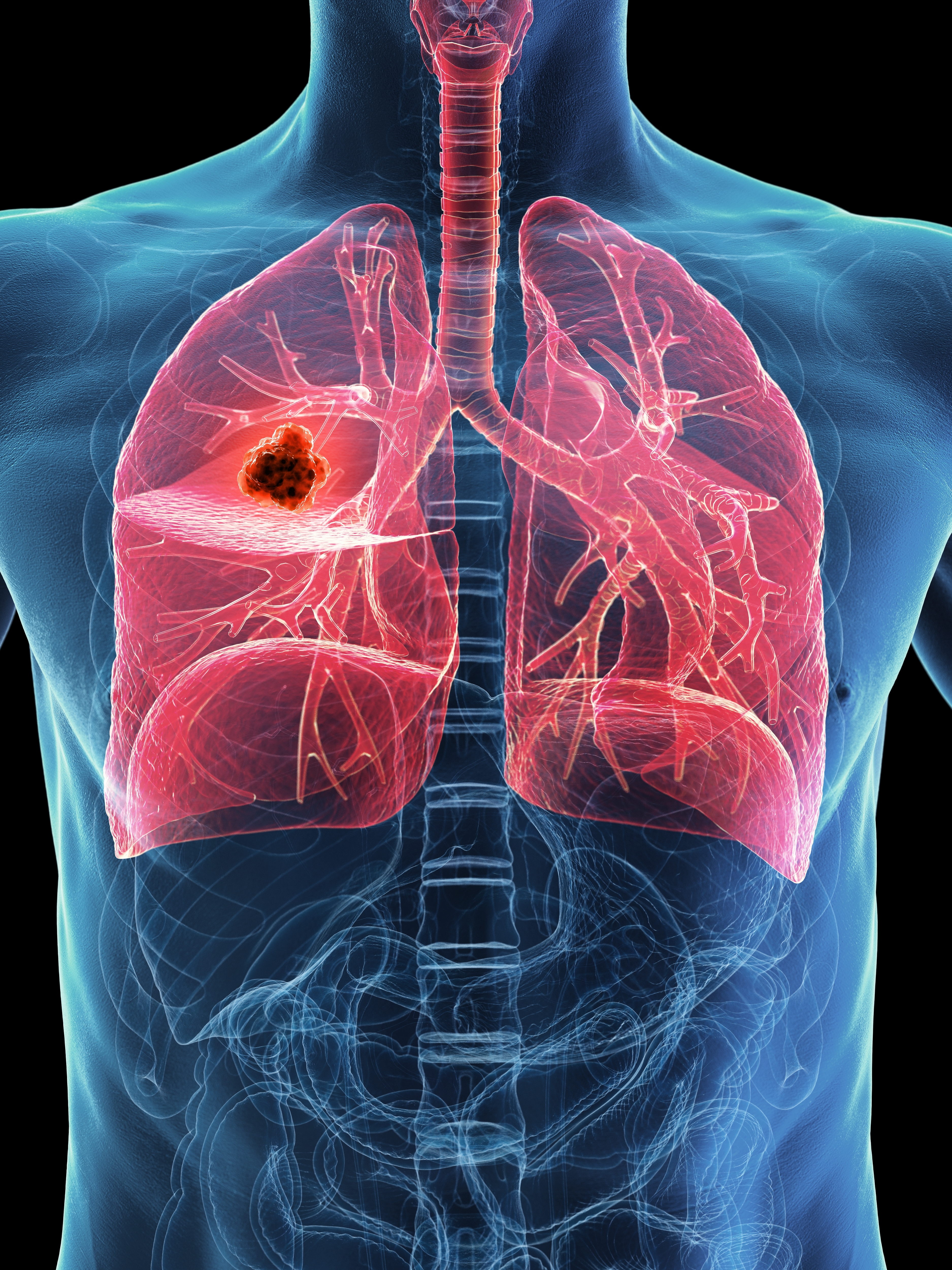 Multidisciplinary Lung Cancer Tumor Board: Management of Surgically Resected Early-Stage EGFRm NSCLC