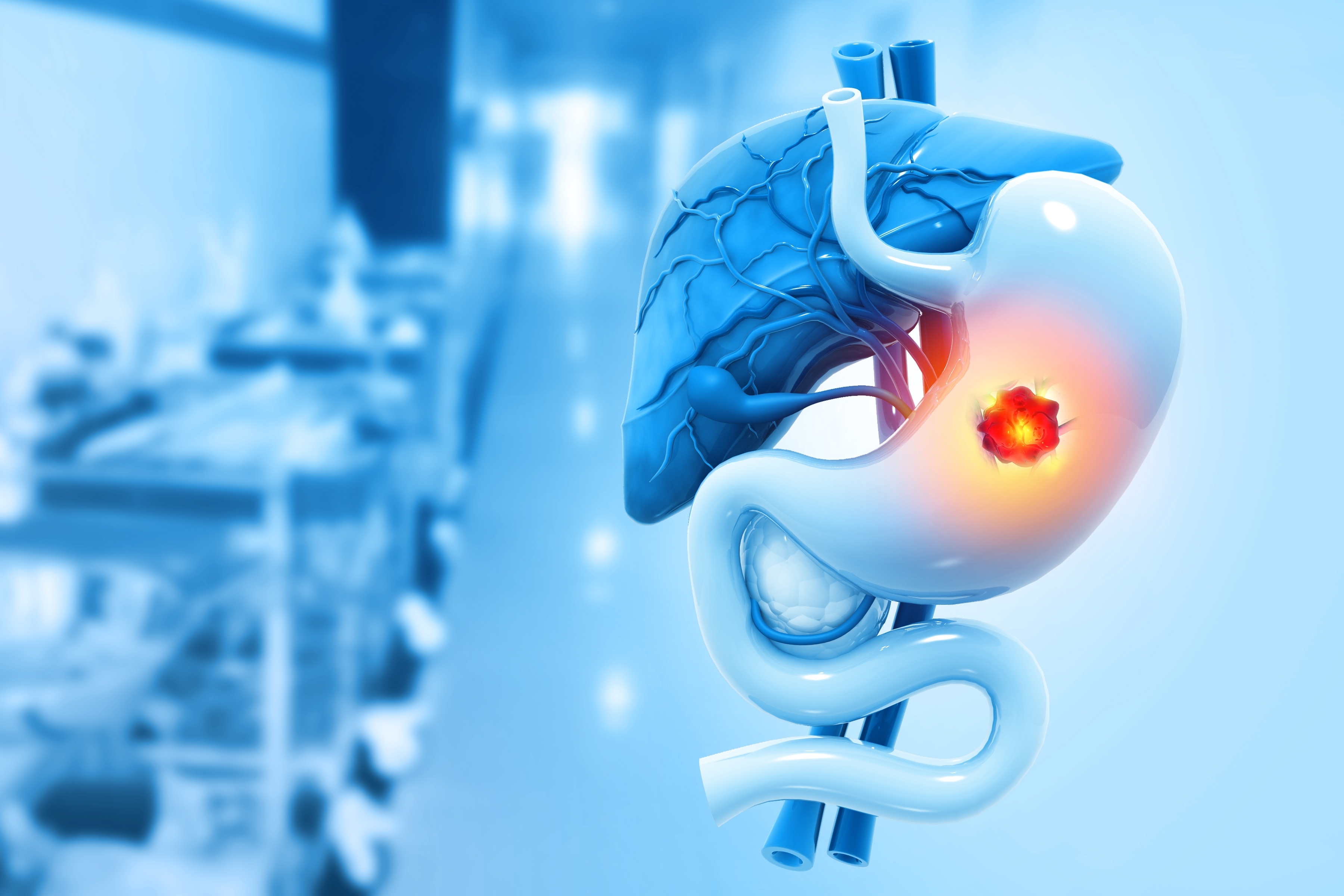 Post ASCO GI Update: The Impact of the Matterhorn Clinical Trial on the Management of Gastric Cancer