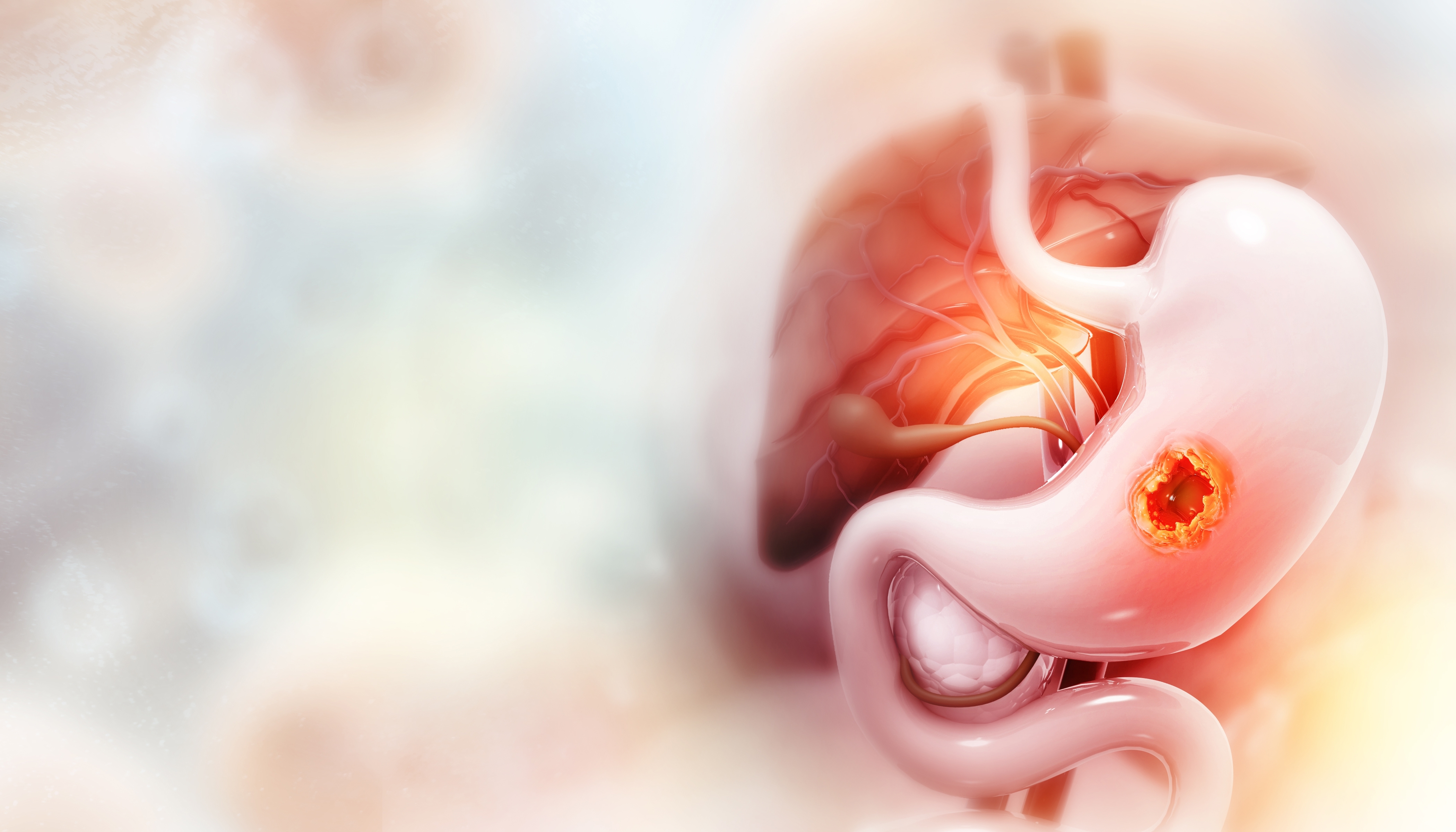 Post ASCO Update on Management of HER2+ Locally Advanced or Metastatic Gastroesophageal Adenocarcinoma